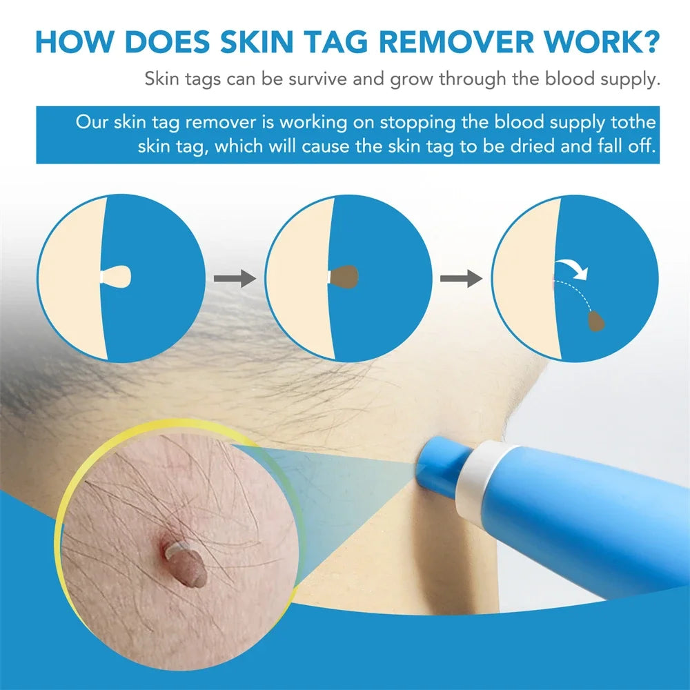 2-in-1 Auto Micro Skin Tag & Wart Remover Kit